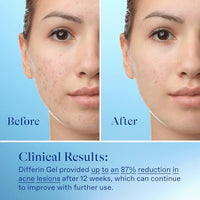 Thumbnail for Differin Acne Treatment Gel