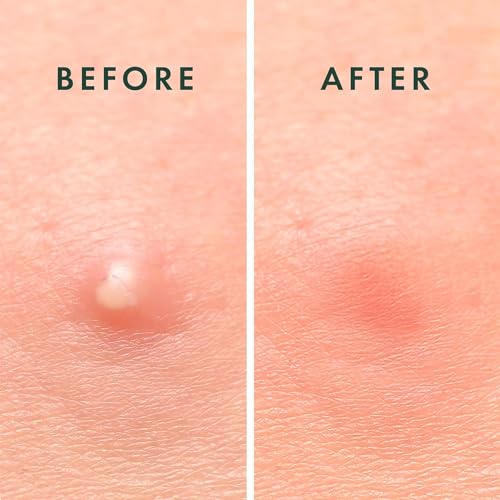 Rael Pimple Patches, Miracle Invisible Spot Cover