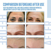 Thumbnail for Before and after comparison of forehead skin with text indicating product effects.