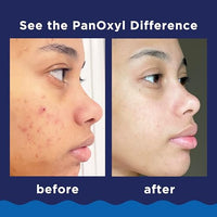 Thumbnail for PanOxyl Acne Foaming Wash Benzoyl Peroxide 10%