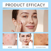 Thumbnail for 20% Azelaic Acid Acne Cream for Face, 20% Azelaic Acid Serum, Clear Tone Skin Cream, It Can Relieve Facial Redness, Balance Excess Oil, Soothe Skin Without Irritation - 0.26 OZ (1pc)