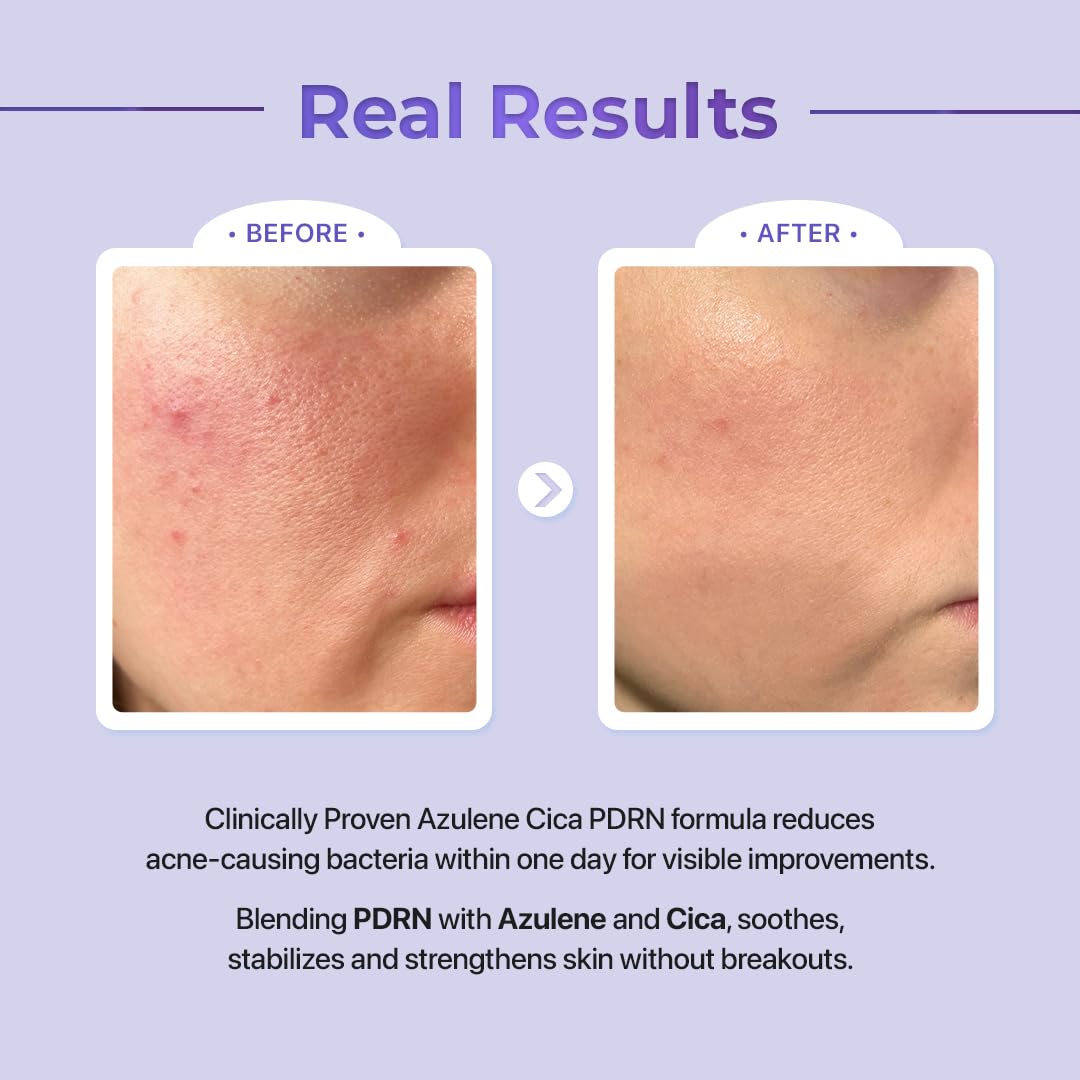 Le Nubele Azulene Cica PDRN Skin Regeneration Set (Serum + Ampoule + Gel Cream) 3-Step Skincare for Sensitive, Acne-Prone, and Aging Skin