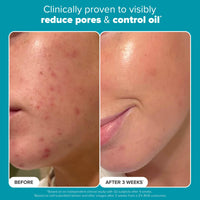 Thumbnail for Paula's Choice SKIN PERFECTING 2% BHA Liquid Salicylic Acid Exfoliant-Facial Exfoliant for Enlarged Pores, Wrinkles & Fine Lines, Suitable for Blackhead-Prone Skin, Fragrance-Free