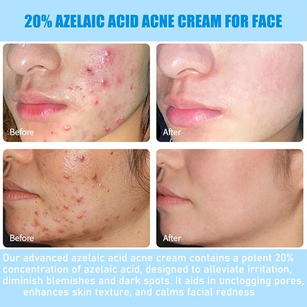 20% Azelaic Acid Acne Cream for Face, 20% Azelaic Acid Serum, Clear Tone Skin Cream, It Can Relieve Facial Redness, Balance Excess Oil, Soothe Skin Without Irritation - 0.26 OZ (1pc)
