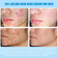 Thumbnail for 20% Azelaic Acid Acne Cream for Face, 20% Azelaic Acid Serum, Clear Tone Skin Cream, It Can Relieve Facial Redness, Balance Excess Oil, Soothe Skin Without Irritation - 0.26 OZ (1pc)